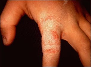 Dermatofitosis o ti&ntilde;a de la mano en el dedo