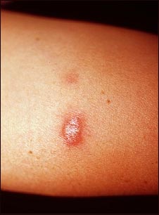 Primer plano de sarcoidosis