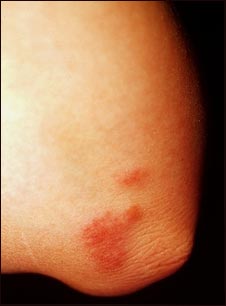 Sarcoidosis en el codo