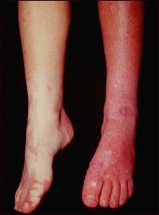 S&iacute;ndrome de Sturge-Weber; piernas