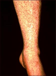 Vasculitis