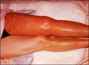 Trombosis venosa profunda, ileofemoral