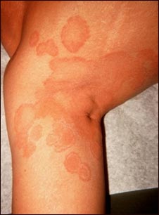 Ti&ntilde;a corporal en la pierna