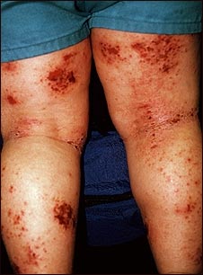 Dermatitis at&oacute;pica de las piernas