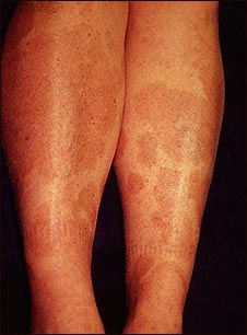 Granuloma anular en las piernas