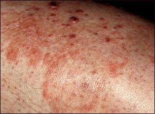 Granuloma por hongos (de Majocchi)