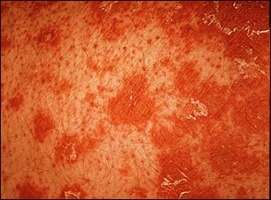 Primer plano de la pitiriasis rubra pilaris