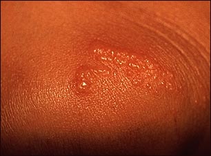 Hiedra venenosa en la rodilla