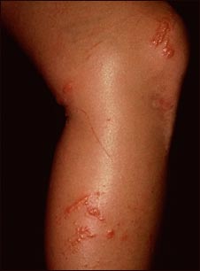 Hiedra venenosa en la pierna