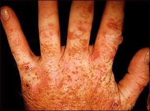Porfiria cut&aacute;nea tard&iacute;a en las manos