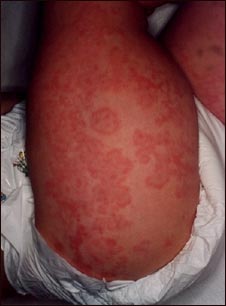 P&uacute;rpura de Henoch-Schonlein en las piernas de un beb&eacute;