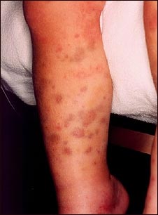 P&uacute;rpura de Henoch-Schonlein en las piernas