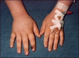 Mordida de serpiente en un dedo