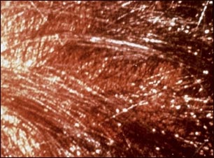 Infestaci&oacute;n de piojos de cabeza en el cuero cabelludo