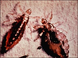 Cuerpo y heces del piojo de cuerpo (pediculus humanus)