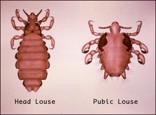 Piojo de cabeza y piojo p&uacute;bico