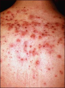 Acn&eacute; vista de cerca de los quistes en la espalda