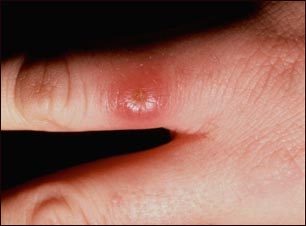 Leishmaniasis en el dedo de la mano