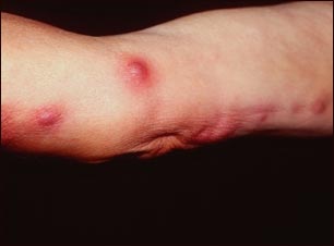 Esporotricosis en el brazo