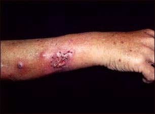 Esporotricosis en el antebrazo