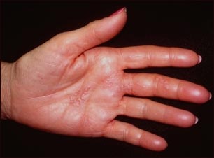 Herpes zoster (culebrilla) en la mano