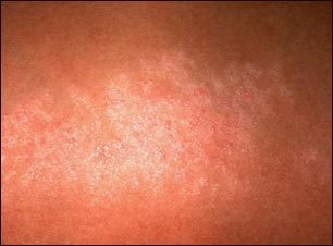 Liquen estriado-primer plano