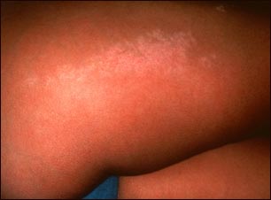 Liquen estriado en la pierna