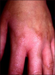 Fitofotodermatitis de la mano