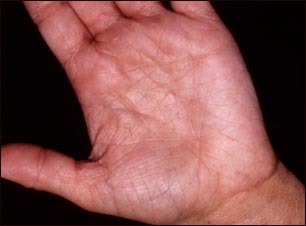 Hiperlinearidad de la dermatitis at&oacute;pica