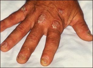 Psoriasis en los nudillos