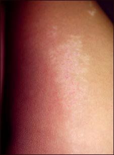 Liquen estriado-primer plano