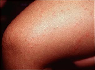 S&iacute;ndrome de Gianotti-Crosti en la pierna