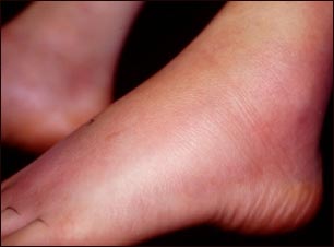 Eritema nodoso en el pie