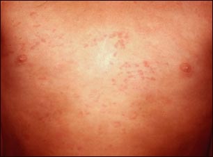 Urticaria en el t&oacute;rax