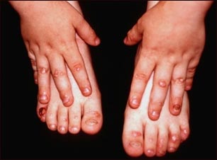 Epiderm&oacute;lisis bullosa, distr&oacute;fica