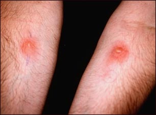 Examen de piel, PPD (brazo derecho) y Candida (izquierdo)