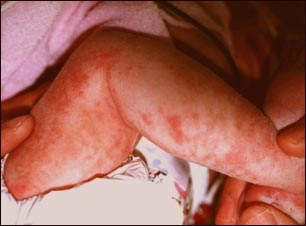 Incontinencia pigmentada en la pierna