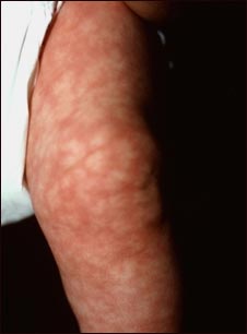 Piel marm&oacute;rea en la pierna