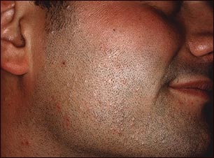 Molusco contagioso en la cara