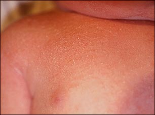 Primer plano de miliaria cristalina