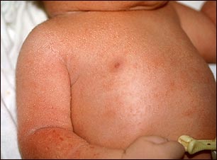 Miliaria cristalina en t&oacute;rax y brazo