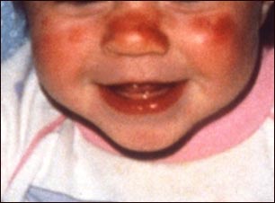 Lupus discoide en el rostro