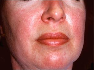 Dermatomiositis; erupci&oacute;n heliotrope en la cara