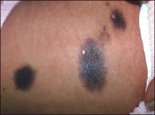 Nevo cong&eacute;nito en el abdomen