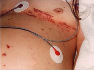 Herpes zoster diseminado