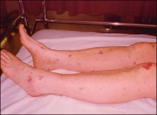 P&uacute;rpura asociada con meningococcemia