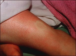 Edema con f&oacute;vea en la pierna