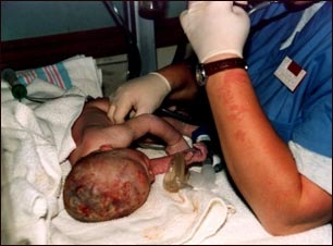 Cuidado del neonato despu&eacute;s del parto