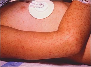 Fiebre maculosa de las Monta&ntilde;as Rocosas, erupci&oacute;n petequial