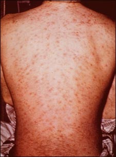 Erupci&oacute;n por drogas en la espalda